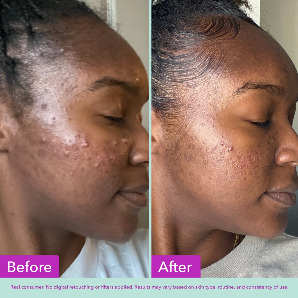 acne-foaming-cleanser-w6 zb_p.jpg
